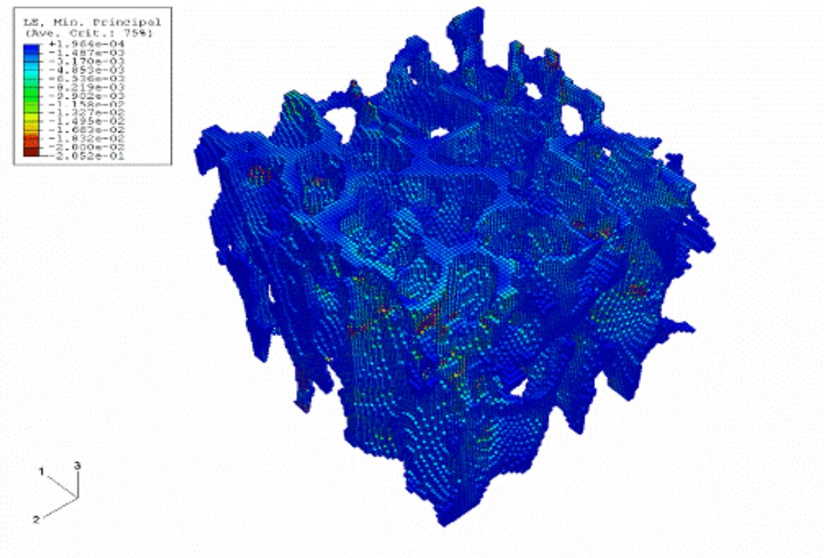 有限元分析助力骨质疏松症的研究